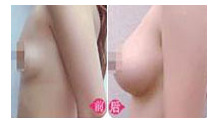 假体材料